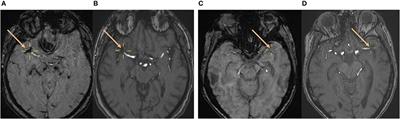 Absence of Susceptibility Vessel Sign in Patients With Malignancy-Related Acute Ischemic Stroke Treated With Mechanical Thrombectomy